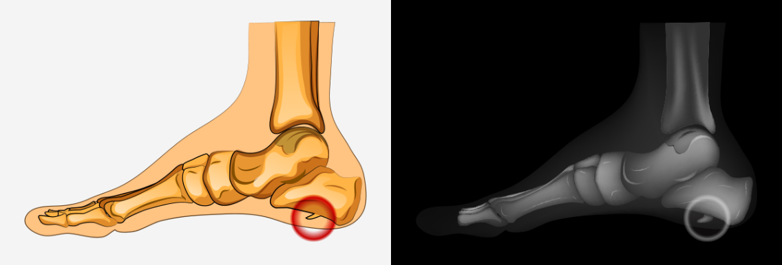 Heel Spur Treatment Frenchs Forest East